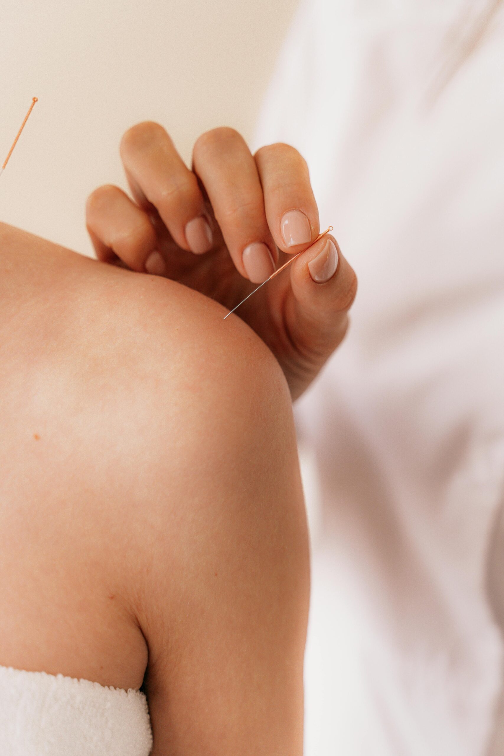Services Close-up of acupuncture needle therapy on a patient's shoulder illustrating alternative medicine.